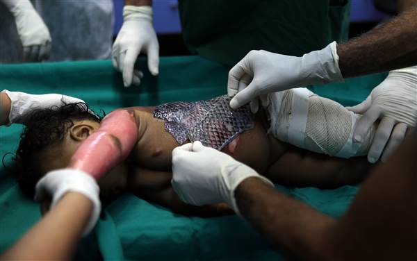 An Experimental Treatment: Doctors in Brazil Use Fish Skin to Treat Burn Victims – NBC News